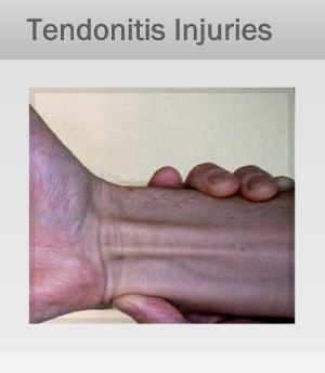 Tendonitis, Tendinosis Treatment Therapy in Marin, San Francisco