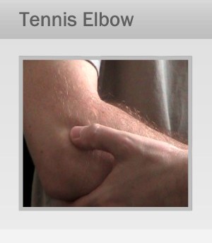 Tennis Elbow Treatment Therapy in Marin, San Francisco